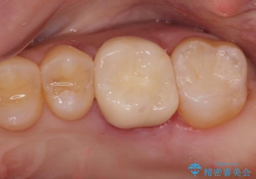金の詰め物の中にある虫歯を除去してセラミック治療の治療後