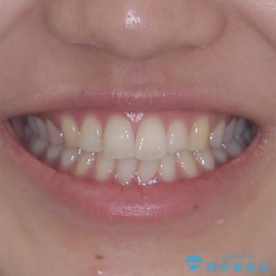 前歯の重なりをインビザライン・モデレートで矯正治療の治療前(顔貌)