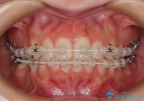 欠損した歯と前に飛び出した前歯　インプラント治療を併用したワイヤー矯正治療の治療中