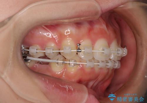 欠損した歯と前に飛び出した前歯　インプラント治療を併用したワイヤー矯正治療の治療中