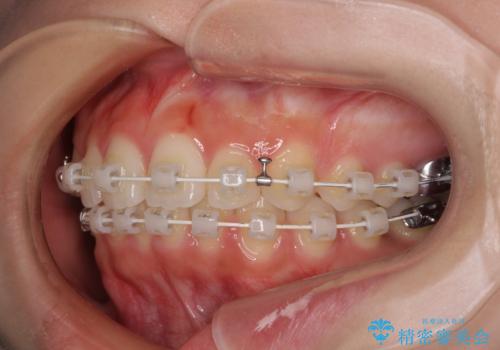 欠損した歯と前に飛び出した前歯　インプラント治療を併用したワイヤー矯正治療の治療中