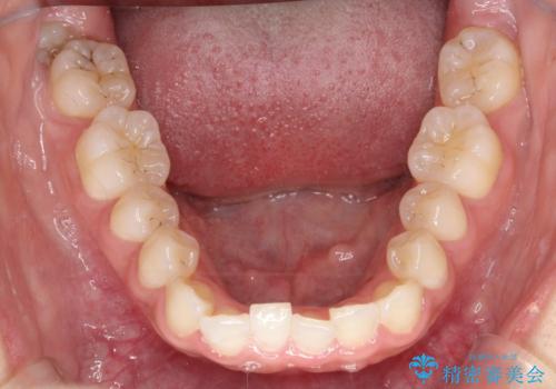 【インビザライン】矮小歯を有する方の矯正治療の治療前