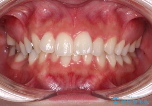 欠損した歯と前に飛び出した前歯　インプラント治療を併用したワイヤー矯正治療の治療前