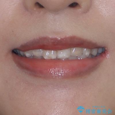 インビザライン・モデレートを用いて気になる前歯を短期間で矯正治療の治療前(顔貌)