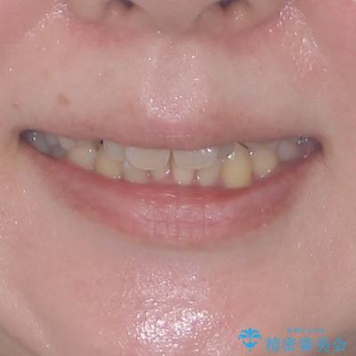 飛び出した上顎前歯と上下のデコボコ 片顎の抜歯によるワイヤー矯正の治療前(顔貌)