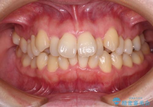 飛び出した上顎前歯と上下のデコボコ 片顎の抜歯によるワイヤー矯正の治療前