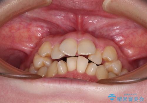 飛び出した上顎前歯と上下のデコボコ 片顎の抜歯によるワイヤー矯正の治療前