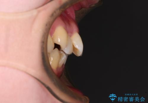 飛び出した上顎前歯と上下のデコボコ 片顎の抜歯によるワイヤー矯正の治療前