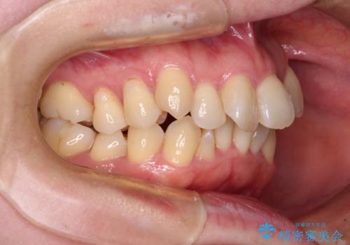 飛び出した上顎前歯と上下のデコボコ 片顎の抜歯によるワイヤー矯正の治療前