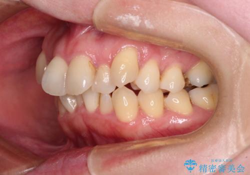 飛び出した上顎前歯と上下のデコボコ 片顎の抜歯によるワイヤー矯正の治療前