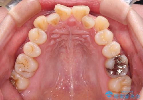 飛び出した上顎前歯と上下のデコボコ 片顎の抜歯によるワイヤー矯正の治療前