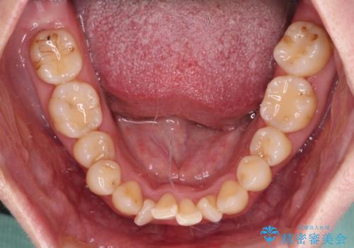 飛び出した上顎前歯と上下のデコボコ 片顎の抜歯によるワイヤー矯正の治療前