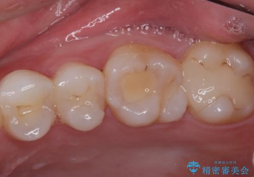 詰め物の下に虫歯があると言われた オールセラミッククラウンの治療前