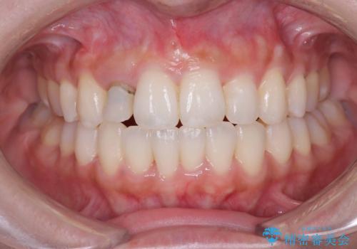 【オールセラミッククラウン】前歯の見た目が気になる!の症例 治療前