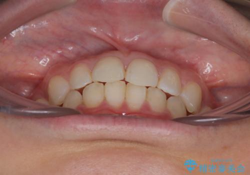 埋もれた奥歯をワイヤーで改善 インビザラインによる矯正治療の治療後