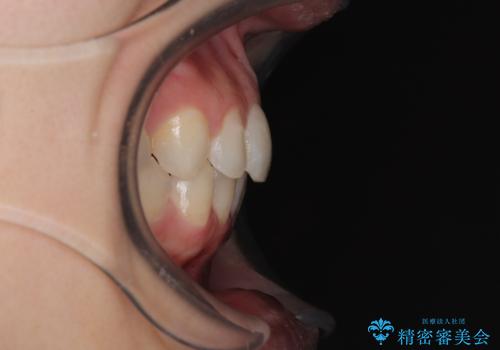 埋もれた奥歯をワイヤーで改善 インビザラインによる矯正治療の治療後