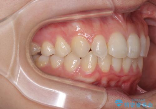 埋もれた奥歯をワイヤーで改善 インビザラインによる矯正治療の治療後