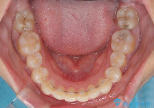 埋もれた奥歯をワイヤーで改善　インビザラインによる矯正治療の治療後
