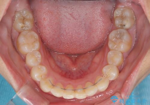 埋もれた奥歯をワイヤーで改善 インビザラインによる矯正治療の治療後