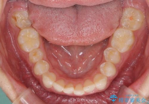 食いしばり癖を改善したい ディープバイトのワイヤー矯正の治療前