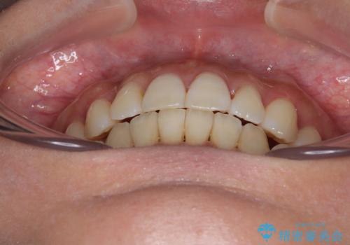 【モニター】上顎前突と奥歯の鋏状咬合 補助装置を用いたインビザライン矯正治療の治療後