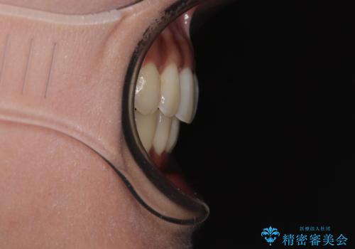 【モニター】上顎前突と奥歯の鋏状咬合 補助装置を用いたインビザライン矯正治療の治療後