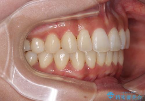 【モニター】上顎前突と奥歯の鋏状咬合 補助装置を用いたインビザライン矯正治療の治療後