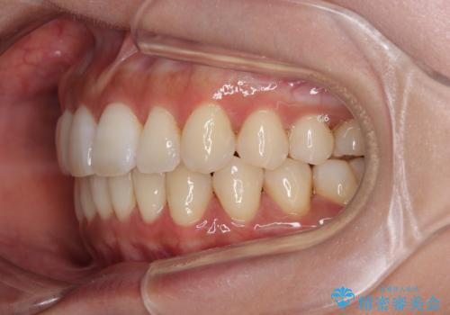 【モニター】上顎前突と奥歯の鋏状咬合 補助装置を用いたインビザライン矯正治療の治療後