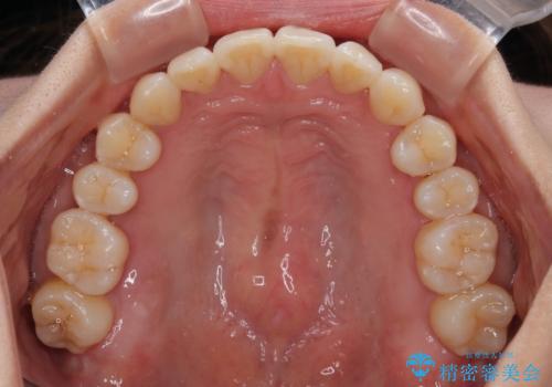 【モニター】上顎前突と奥歯の鋏状咬合 補助装置を用いたインビザライン矯正治療の治療後