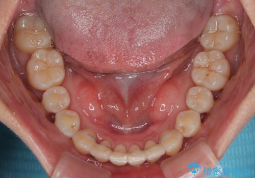 【モニター】上顎前突と奥歯の鋏状咬合 補助装置を用いたインビザライン矯正治療の治療後