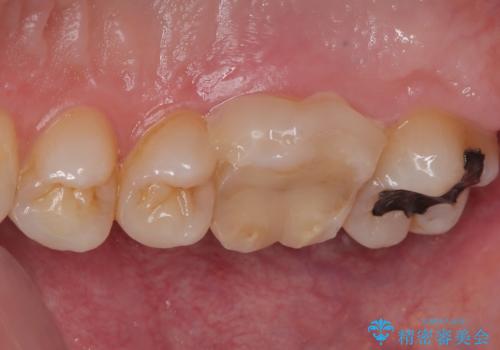 歯が割れた オールセラミッククラウンの治療前