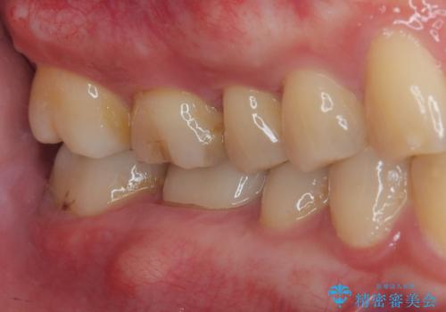 歯が割れた オールセラミッククラウンの治療前