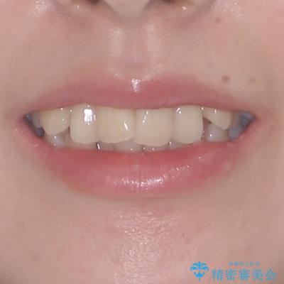 デコボコと出っ歯 抜歯矯正でスッキリとした口元にの治療前(顔貌)