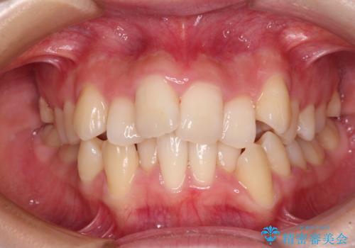 デコボコと出っ歯 抜歯矯正でスッキリとした口元にの症例 治療前