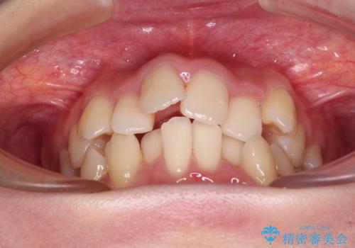 デコボコと出っ歯 抜歯矯正でスッキリとした口元にの治療前