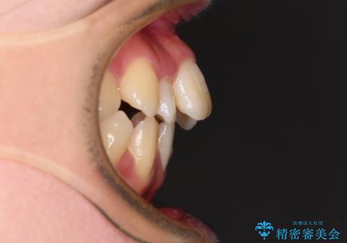 デコボコと出っ歯 抜歯矯正でスッキリとした口元にの治療前