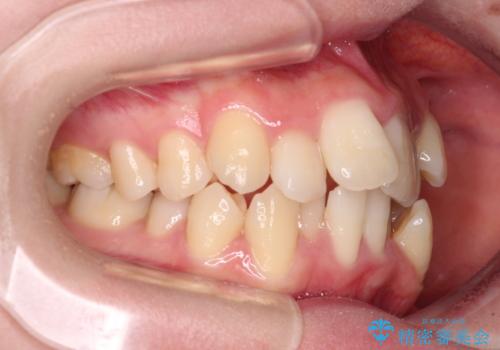 デコボコと出っ歯 抜歯矯正でスッキリとした口元にの治療前