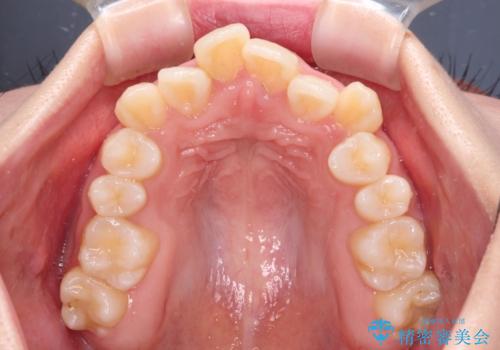 デコボコと出っ歯 抜歯矯正でスッキリとした口元にの治療前