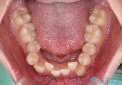 デコボコと出っ歯 抜歯矯正でスッキリとした口元にの治療前