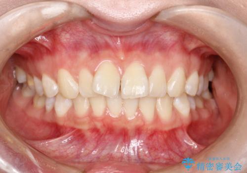 前歯のガタつきを治したい 翼状捻転マウスピース矯正