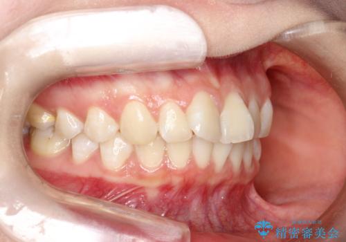 前歯のガタつきを治したい 翼状捻転マウスピース矯正の治療前