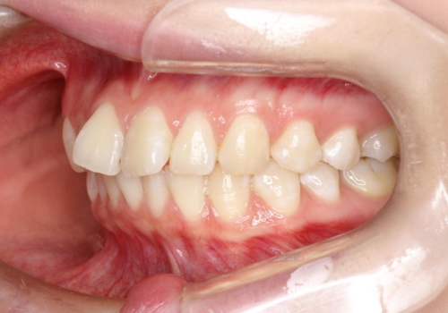 前歯のガタつきを治したい 翼状捻転マウスピース矯正の治療前