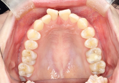 前歯のガタつきを治したい 翼状捻転マウスピース矯正の治療前