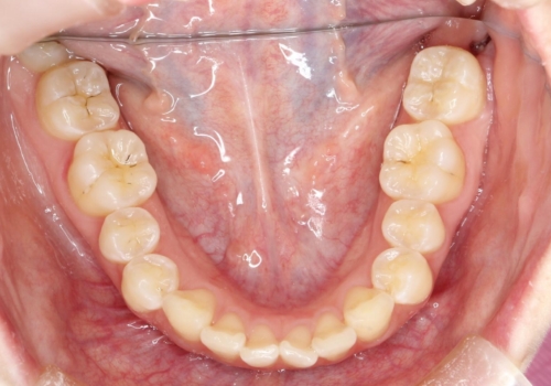 前歯のガタつきを治したい　翼状捻転マウスピース矯正の治療前
