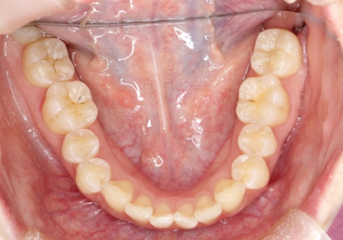 前歯のガタつきを治したい 翼状捻転マウスピース矯正の治療前