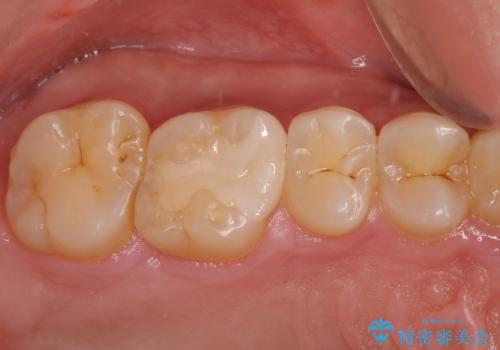 銀歯を白くしたい　セラミックインレー修復の治療後