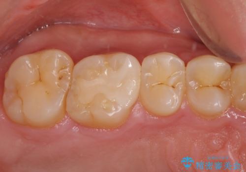 銀歯を白くしたい セラミックインレー修復