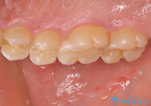 銀歯を白くしたい セラミックインレー修復の治療後