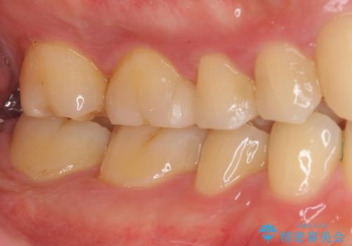 銀歯を白くしたい セラミックインレー修復の治療後