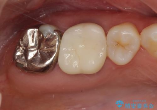 金属の詰め物が取れた。セラミックを入れたい! オールセラミッククラウンの治療後